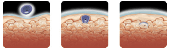 82% Acne clearance with PDT