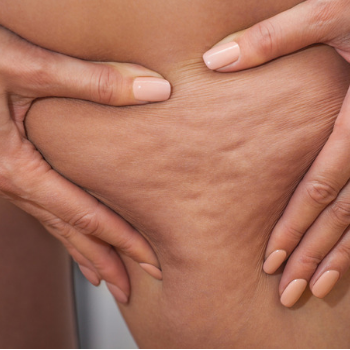 Cellulite: what you need to know