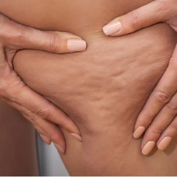 Hands pressing skin on a thigh illustrating an archived health article at 23MD