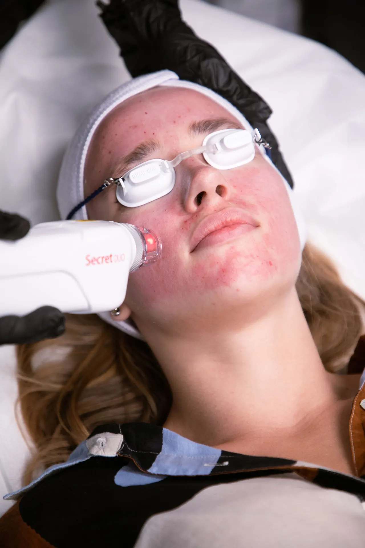 A laser applicator being applied to a patient's cheek during skin treatment at 23MD