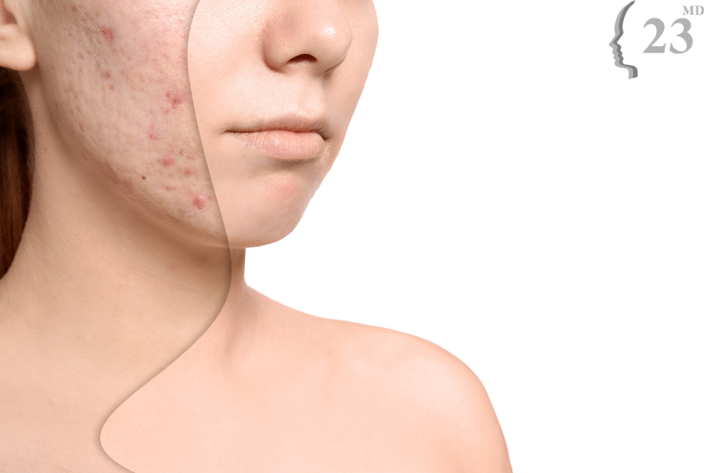 Everything you should know about acne scars