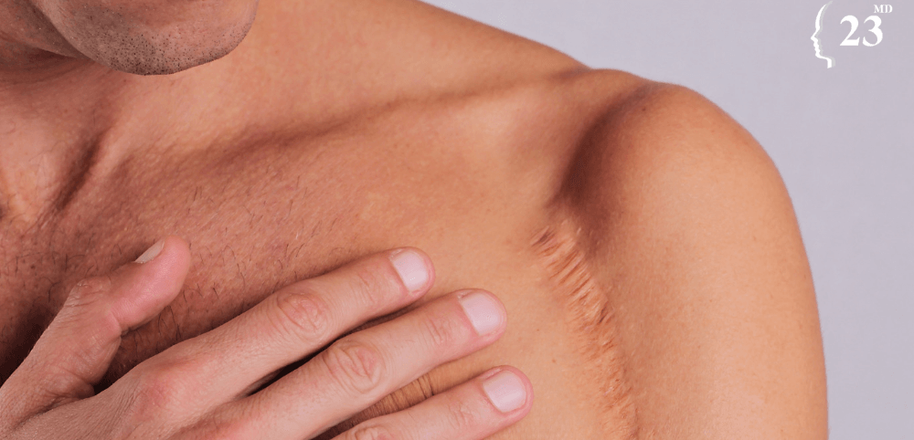 How can I reduce the appearance of my scars?
