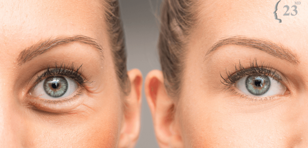 How to reduce dark circles under the eyes
