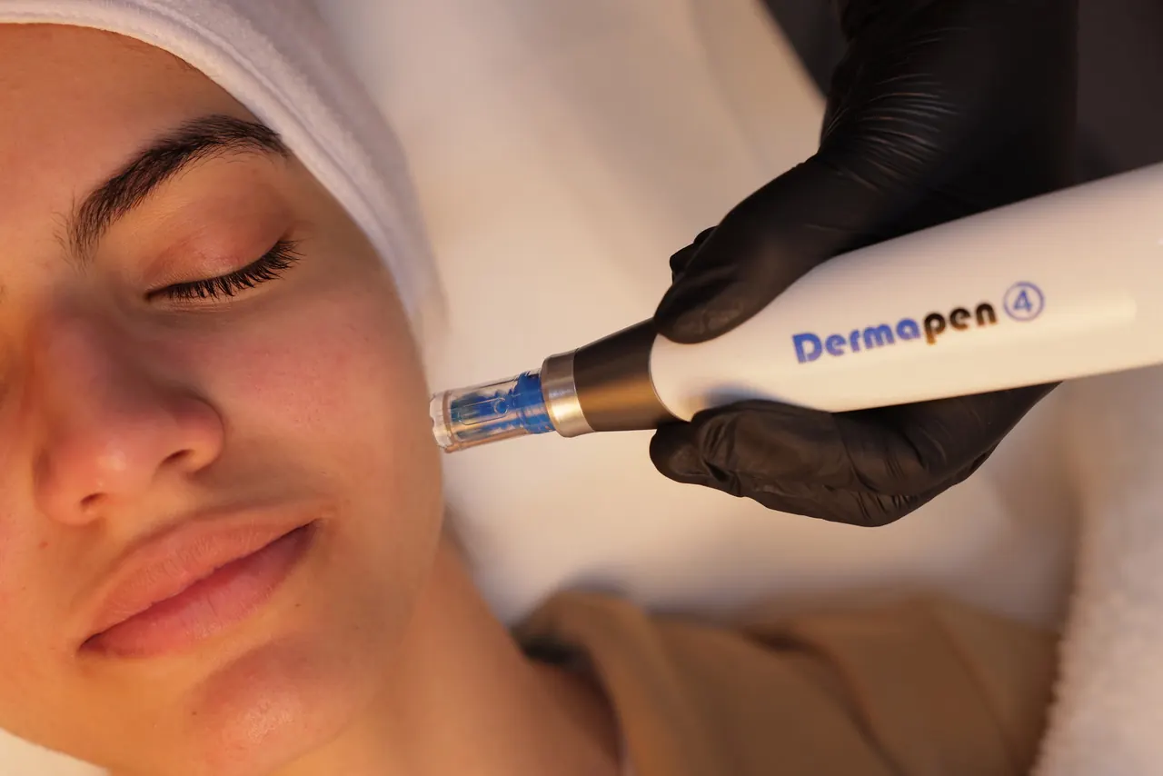 A reclining patient receiving pen microneedling on the face illustrating an archived health article at 23MD