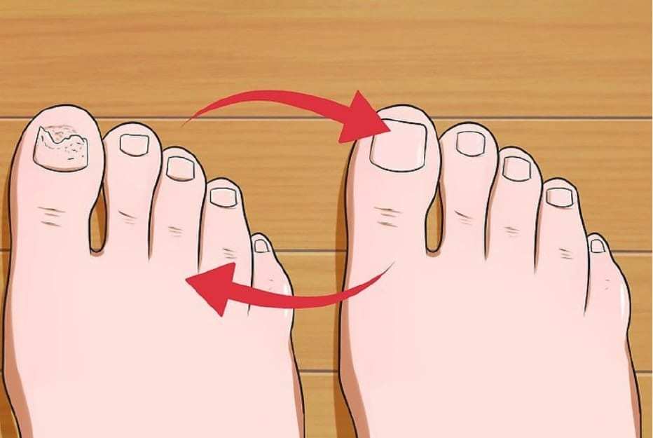 Laser your Fungal Nails back to health at 23MD