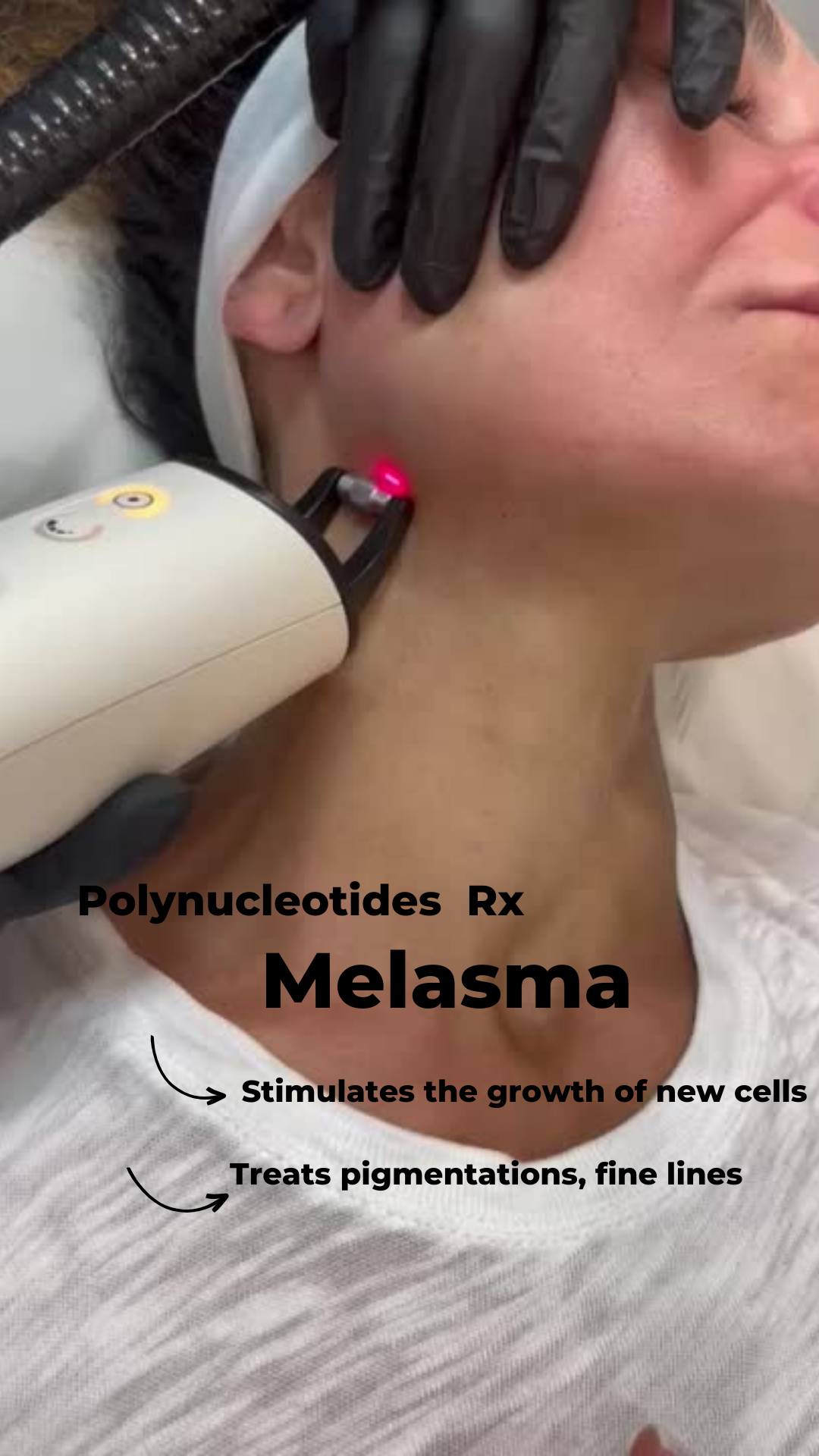 Melasma Treatments at 23MD
