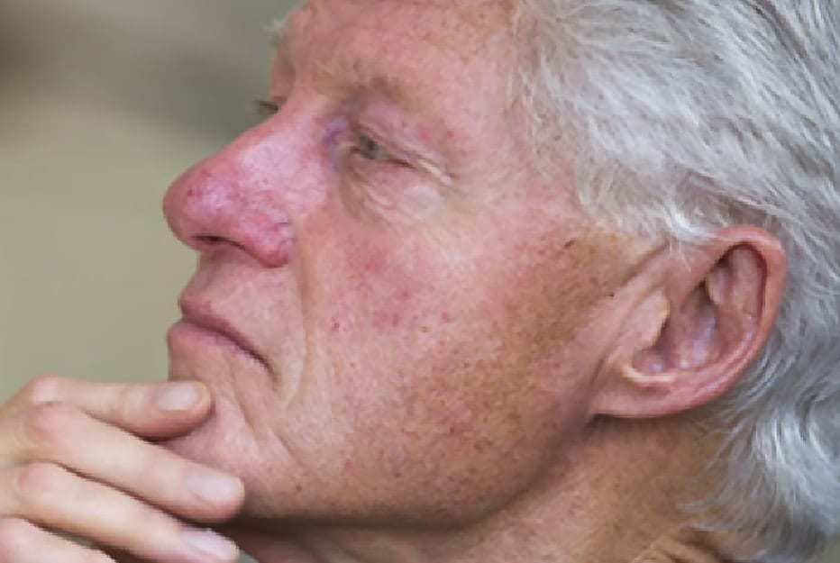 Rosacea - Reduce and Control